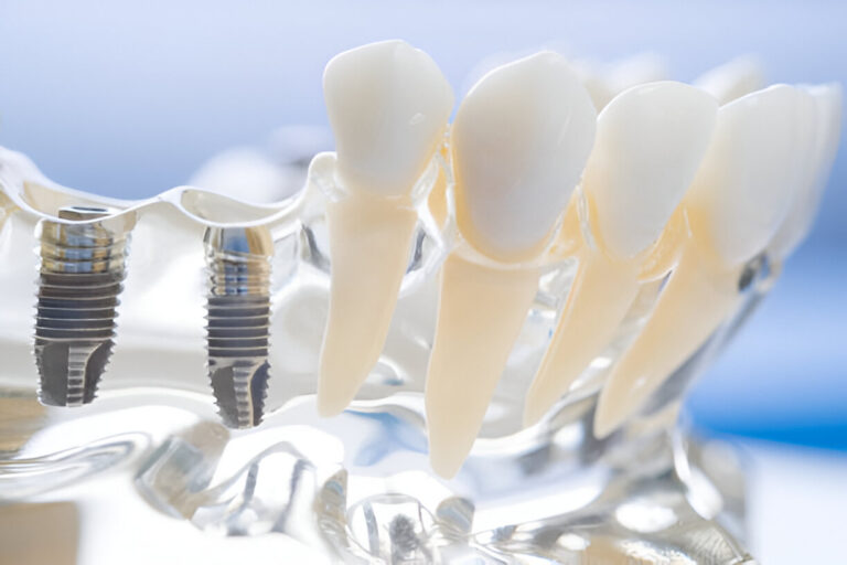 The Essential Guide to Affordable Dental Implants