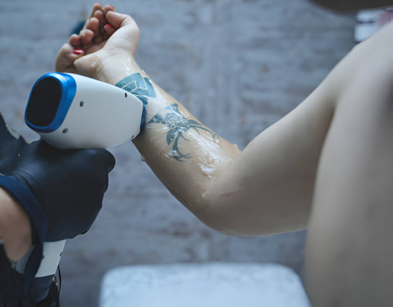 Tattoo Removal and Skin Health: Long-Term Considerations